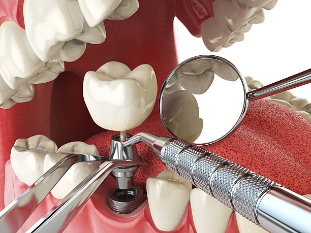 Best Emergency Root Canal Treatment in Safety Harbor, FL